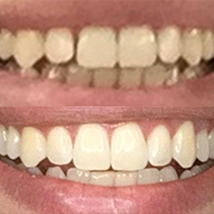 EZ SMILE Results