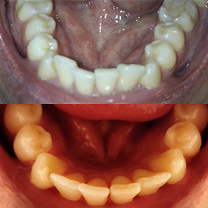 EZ SMILE Results