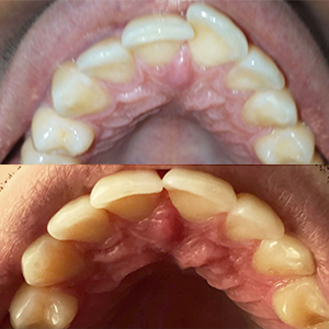 EZ SMILE Results