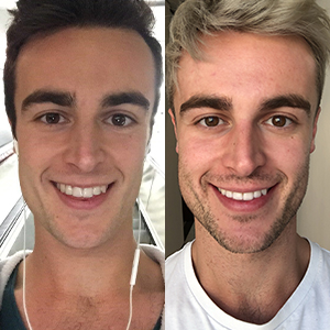 EZ SMILE Results