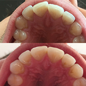 EZ SMILE Results