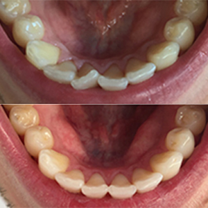EZ SMILE Results