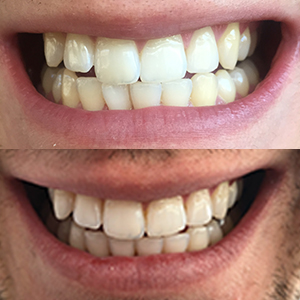 EZ SMILE Results
