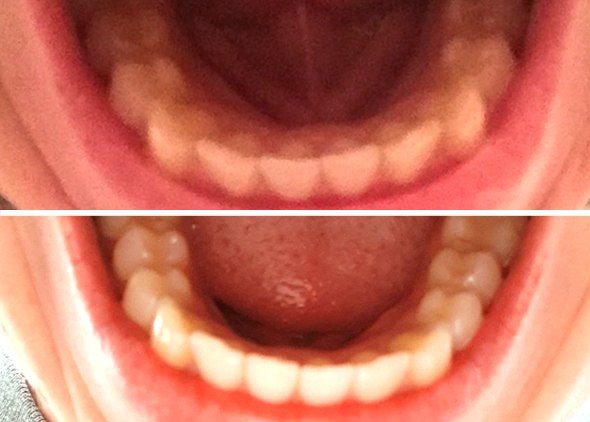 Nadia Lower Teeth