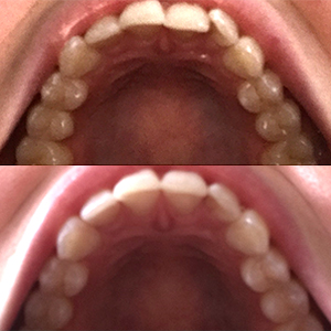 EZ SMILE Results