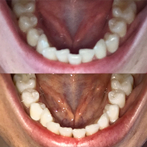 EZ SMILE Results