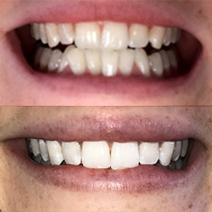 EZ SMILE Results