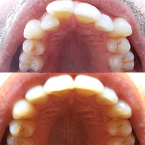 EZ SMILE Results