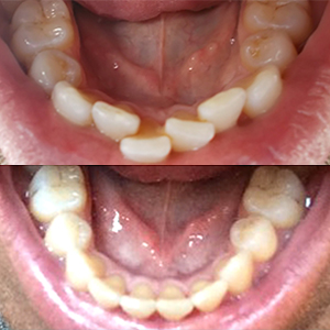EZ SMILE Results