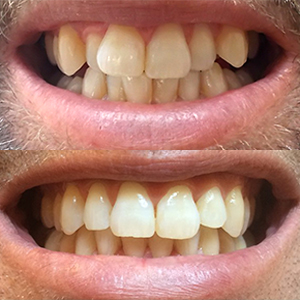 EZ SMILE Results