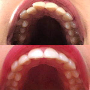 EZ SMILE Results