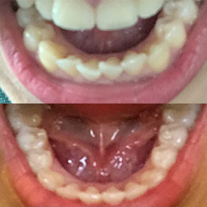 EZ SMILE Results