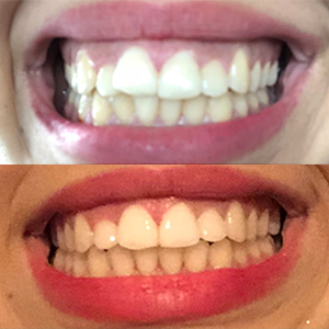 EZ SMILE Results