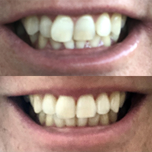 EZ SMILE Results