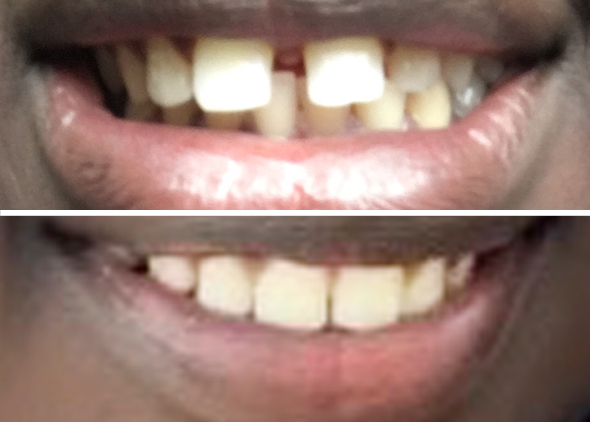 Rimaz Front Teeth