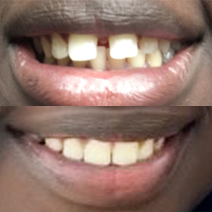 EZ SMILE Results