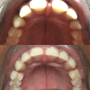 EZ SMILE Results