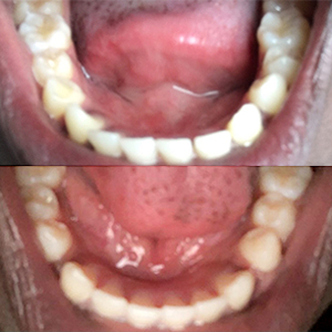 EZ SMILE Results