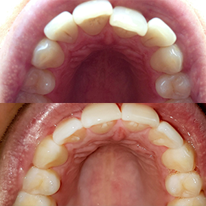 EZ SMILE Results