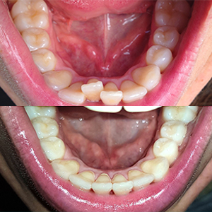 EZ SMILE Results