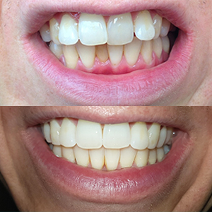 EZ SMILE Results