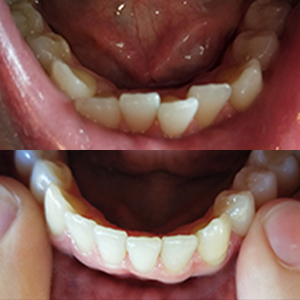EZ SMILE Results