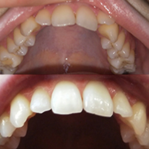EZ SMILE Results