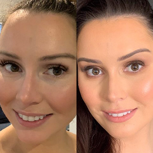 EZ SMILE Results