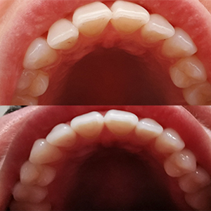 EZ SMILE Results