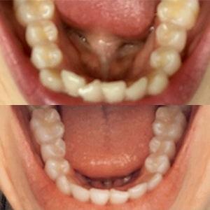 EZ SMILE Results