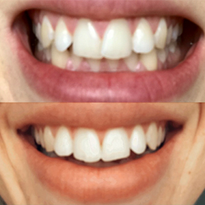 EZ SMILE Results