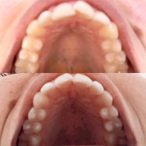 EZ SMILE Results