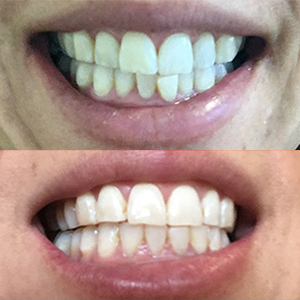 EZ SMILE Results