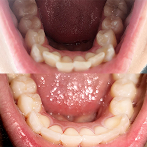 EZ SMILE Results
