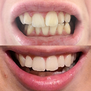 EZ SMILE Results