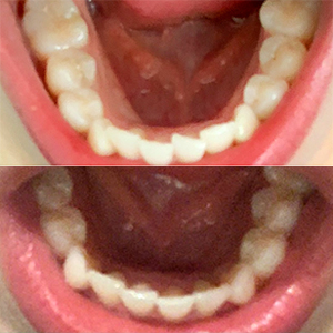 EZ SMILE Results