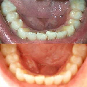 EZ SMILE Results