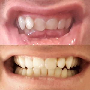 EZ SMILE Results