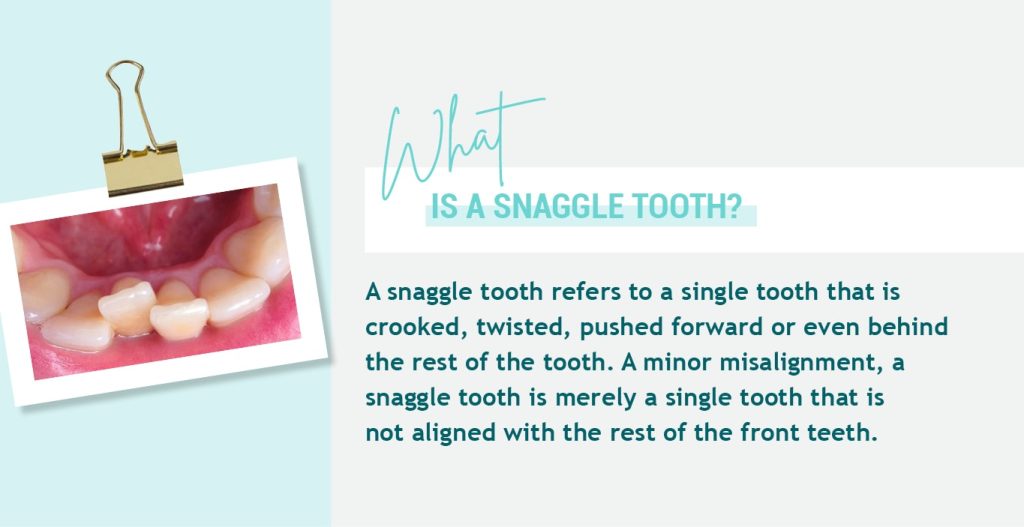 Fixing Snaggle Tooth with Invisible Aligners EZ SMILE