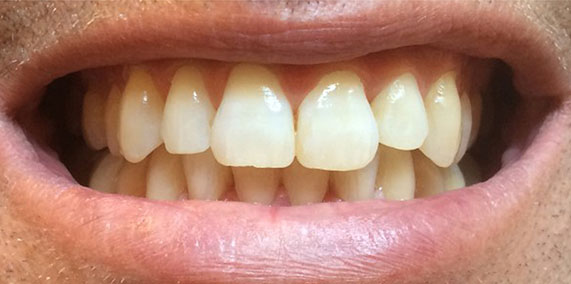 EZ SMILE Before & After