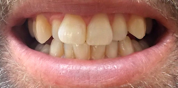 EZ SMILE Before & After
