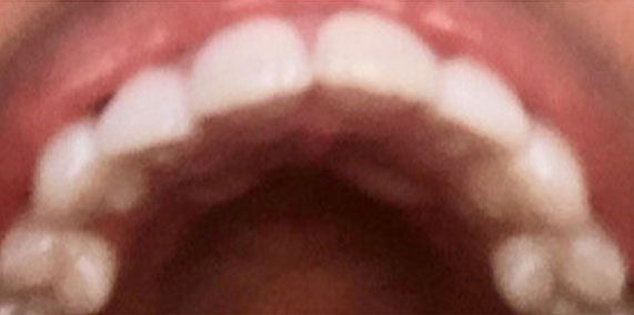 EZ SMILE Before & After