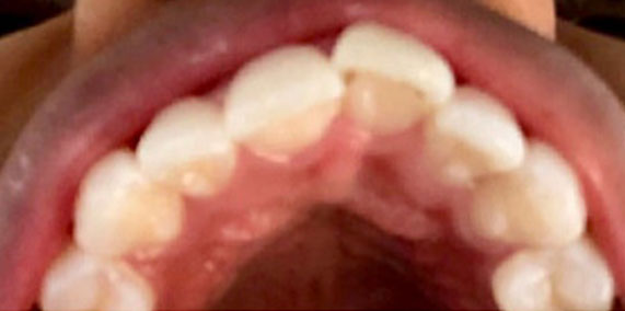 EZ SMILE Before & After