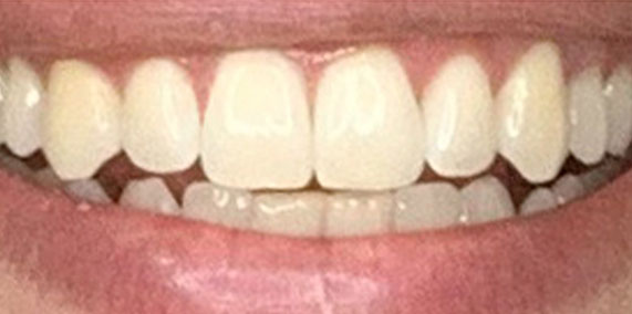 EZ SMILE Before & After