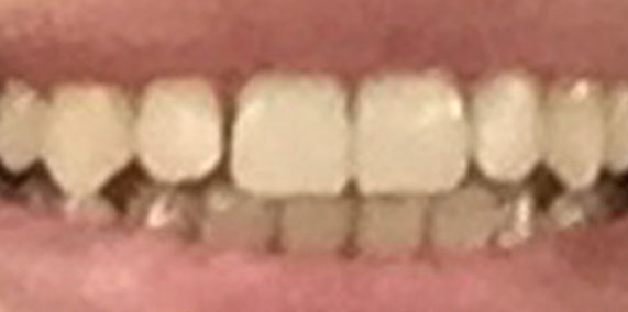 EZ SMILE Before & After