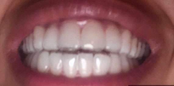 EZ SMILE Before & After