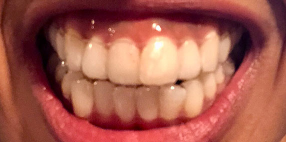 EZ SMILE Before & After