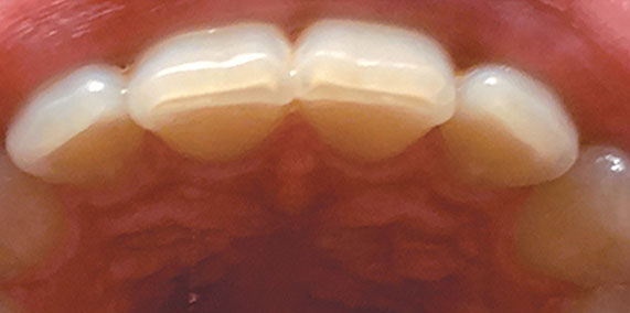 EZ SMILE Before & After