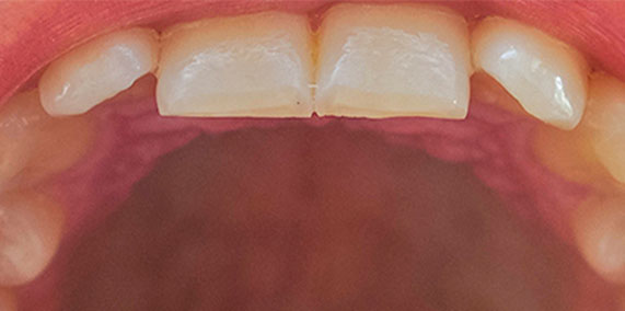 EZ SMILE Before & After