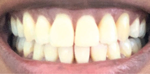 EZ SMILE Before & After
